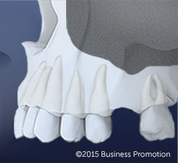 InadequateBone2